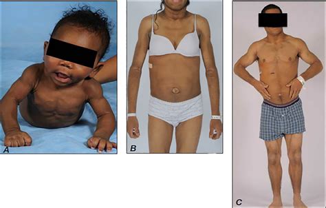 The Clinical Approach to the Detection of Lipodystrophy an Aace Consensus Statement - Endocrine ...