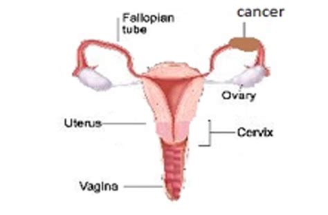 Fallopian Tube Cancer