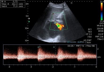 Hepatic Artery Ultrasound