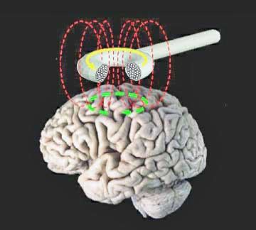 Transcranial Magnetic Stimulation (TMS) Fibromyalgia Study Produces Lasting Relief - Health Rising