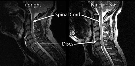 Spinal Cord Compression While Upright