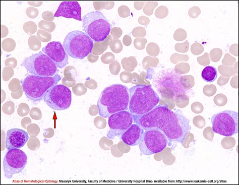 Acute myeloid leukaemia without maturation - CELL - Atlas of ...