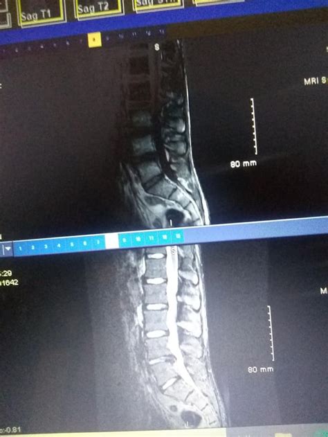 Mri results : r/Sciatica