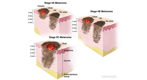 Early Subungual Melanoma Symptoms - Doctor Heck