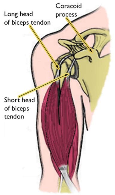 Biceps Tendinitis - OrthoInfo - AAOS