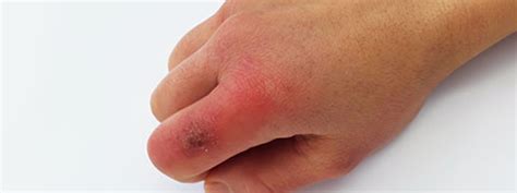 Chilblains: Causes, Symptoms And Treatment