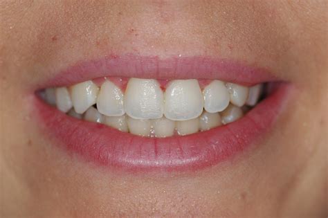 Grupo de estudios odontológicos de Cuenca: Sonrisa gingival