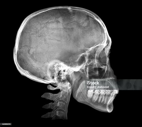 Human Skull Xray Image Stock Photo - Download Image Now - X-ray Image, Medical X-ray, Human ...