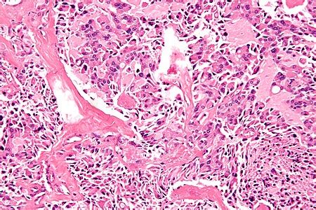 Medullary thyroid carcinoma - Libre Pathology