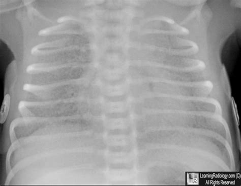 Rds X Ray In Newborn : Respiratory Distress Syndrome Radiology ...