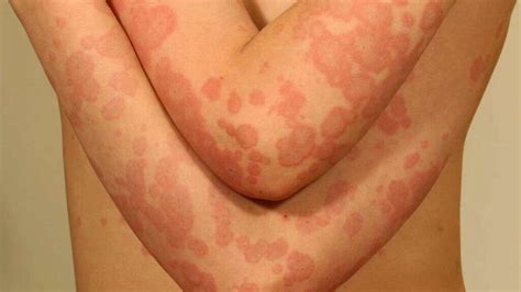 Erythema Multiforme: What Is Erythema Multiforme?