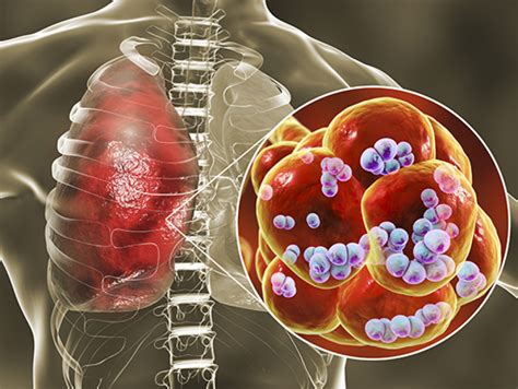 An atlas of S. pneumoniae and host gene expression during colonization and disease - News | UAB