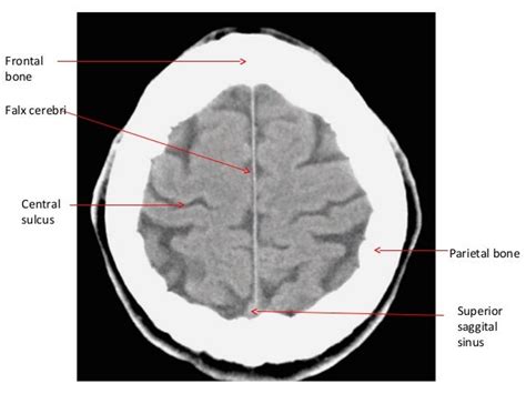 CT Scan Head basics