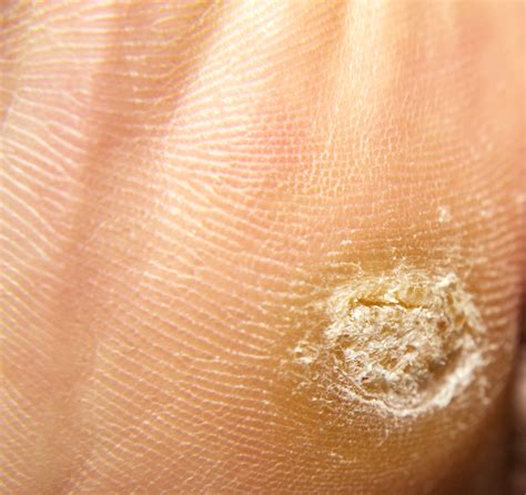 Epidermolytic hyperkeratosis: MedlinePlus Genetics