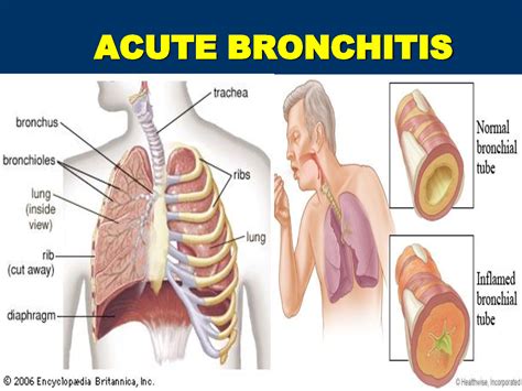 Homoeo Life Plus - Cures and Cares: HOMOEOPATHY FOR BRONCHITIS