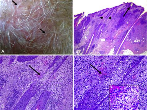 Erosive pustular dermatosis of the scalp: A neutrophilic folliculitis within the spectrum of ...