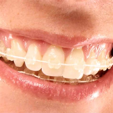 Essential Benefits Of Clear Braces For Adults