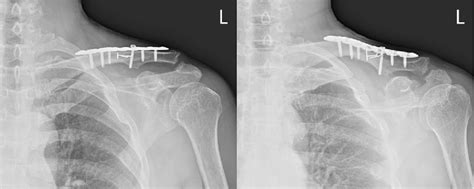 Radiographs taken at 15 months after surgery showing AC joint arthritis ...