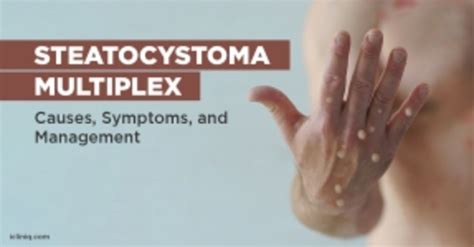 Health Articles in Steatocystoma Multiplex