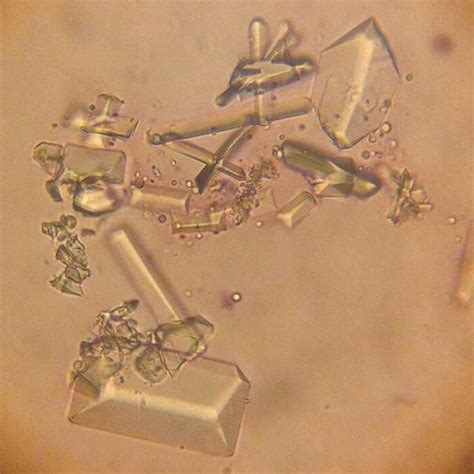 Picture of struvite crystals in the urine of a 3.5 year old dog ...