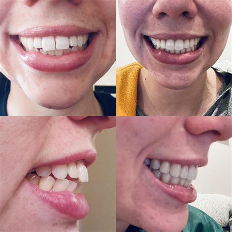 All done! Invisalign fixed my open bite! : Invisalign