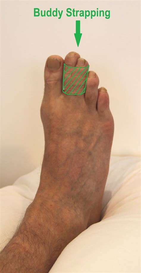 Toe fracture or dislocation · Virtual Fracture Clinic