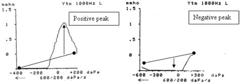 Tympanometry test, tympanometry types & abnormal tympanometry results