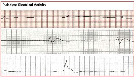 ECG Rhythms - National CPR Association