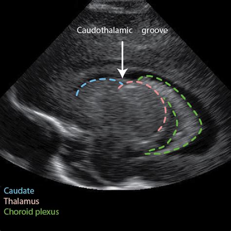 Caudothalamic groove | Radiology Reference Article | Radiopaedia.org ...