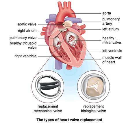 Heart Surgery Types - Open, Bypass, Ablation, Heart Valve surgery