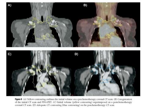 Radiation therapy for early stage hodgkin’s lymphoma