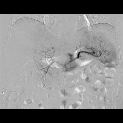 A celiac artery angiogram with opacification of the hepatic artery.... | Download Scientific Diagram