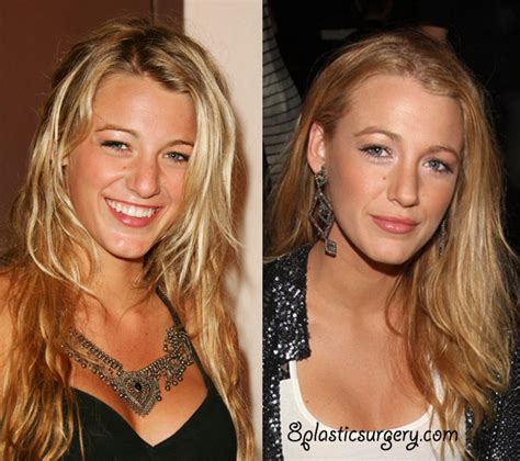 Blake Lively ~ 100 plastic surgery