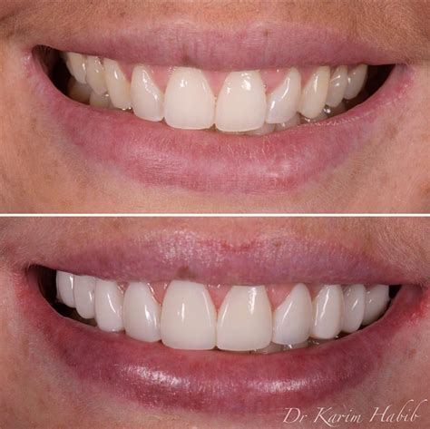 Composite Veneers Sydney | Dental Bonding Sydney - Dentist Ryde | Gladesville | Putney | North Ryde