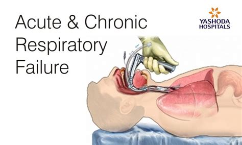 Acute and Chronic Respiratory Failure treatment and diagnostic