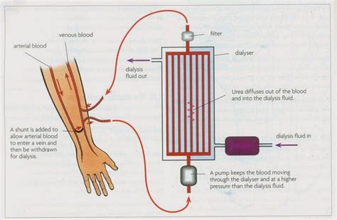 Dialysis - Biology Notes for IGCSE 2014