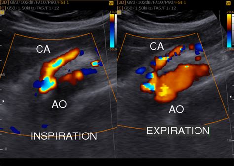 Figure 3A. Color Doppler ultrasound revealed severe stenosis of proximal celiac artery noted ...