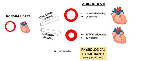 Athlete’s Heart (the disease) - What it is & What we should know