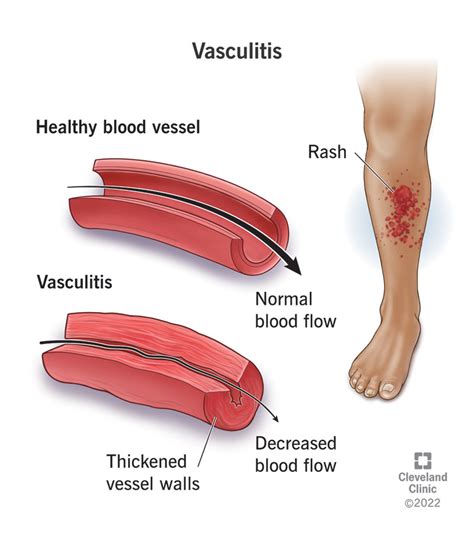 Vasculitis: Symptoms, Types & Treatment