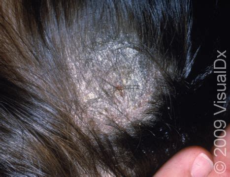 Tinea Capitis (scalp Ringworm): Causes, Symptoms, And, 57% OFF