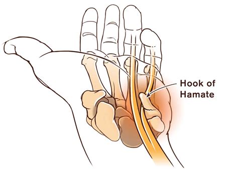 MT Endangerment Sites: 23. Hook of Hamate Bone