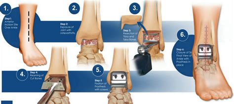 Facts About Ankle Replacement Surgery