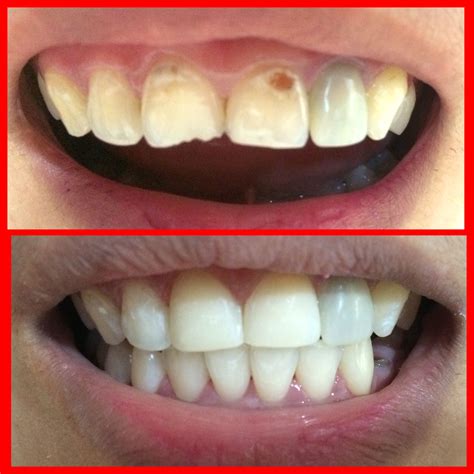 before and after tooth restoration (tooth # 11 & 12) | Dental, Dental ...