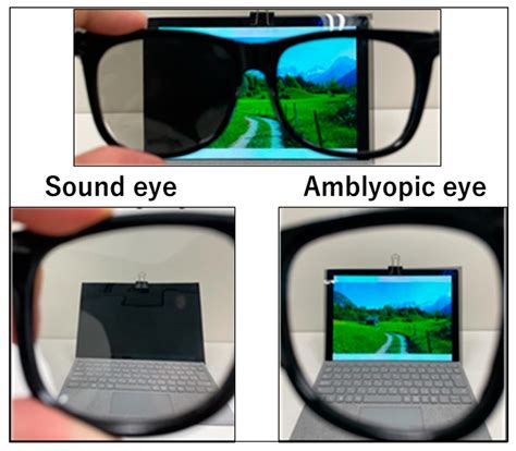 Children | Free Full-Text | Comparison of Amblyopia Treatment Effect ...