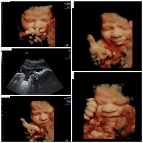 Pin on 3d Ultrasound Baby Images