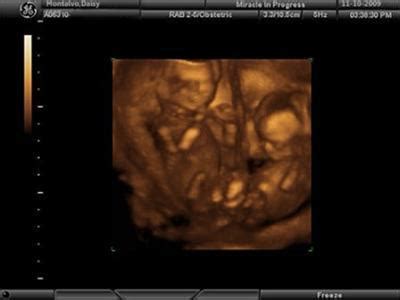 My Babies - 3D Twins Ultrasound