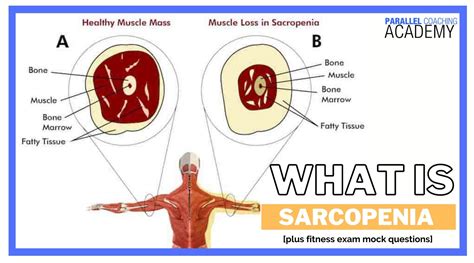 What is Sarcopenia? (muscle loss with aging)