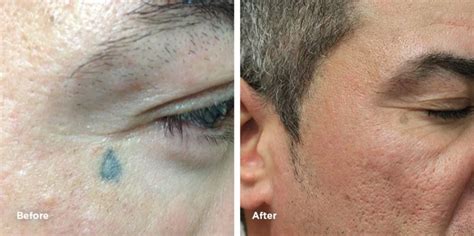 Face Tattoo Removal Results | Case Study | Removery