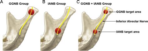 Anesthetic Efficacy of Gow-Gates Nerve Block, Inferior Alveolar Nerve ...