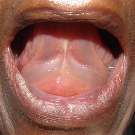 Picture of Angioedema * Otolaryngology Houston